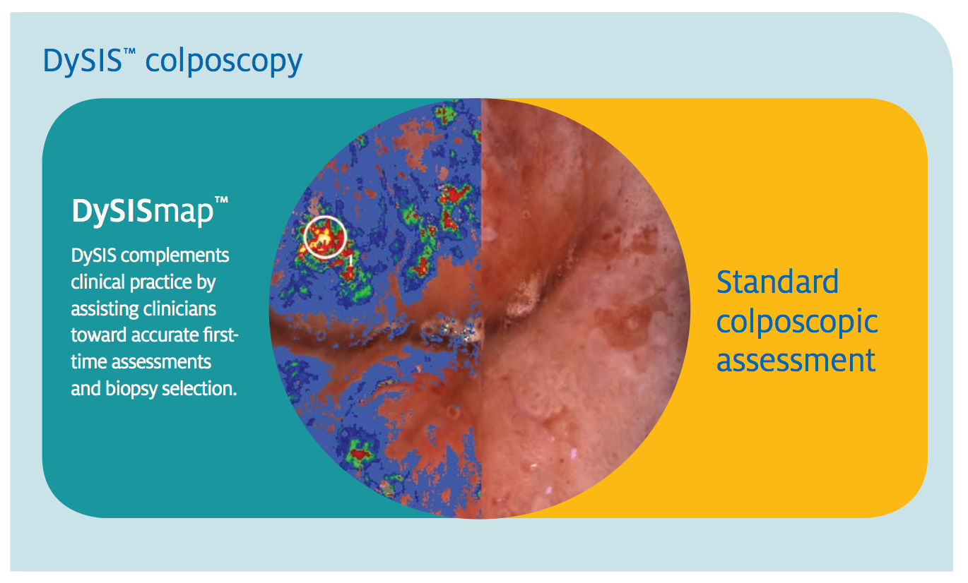 Abnormal Pap Colposcopy Biopsy